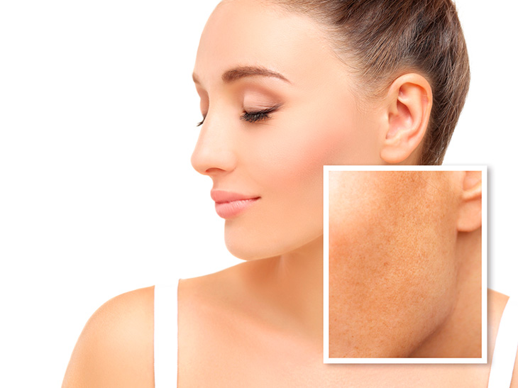 Melasma: dermatologista afirma que há peles mais suscetíveis a esse tipo de mancha